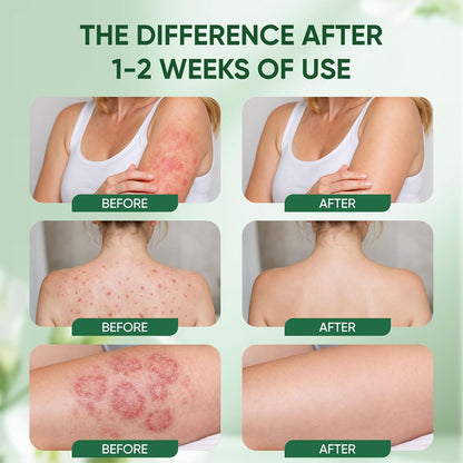 Healora Intertrigo Relief Cream
